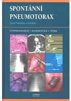 Spontánní pneumotorax