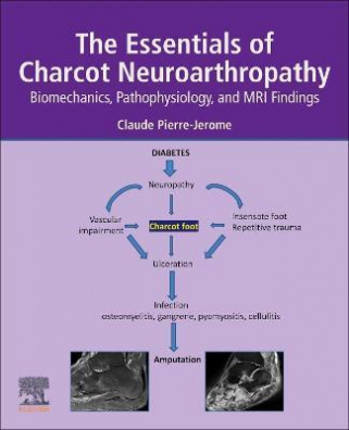 The Essentials of Charcot Neuroarthropathy : Biomechanics, Pathophysiology, and MRI Findings
