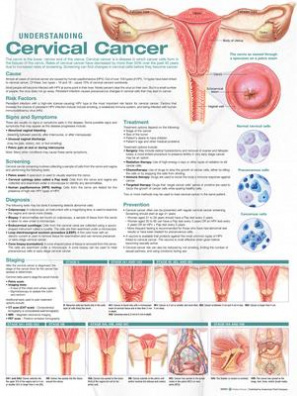 Understanding Cervical Cancer Anatomical Chart 2nd edition