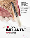 Zub vs. Implantát. Zachovat, či nahradit vážně poškozený zub?