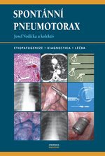 Spontánní pneumotorax - Etiopatogeneze, diagnostika a léčba