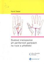 Svalové transpozice při periferních parézách na ruce a předloktí